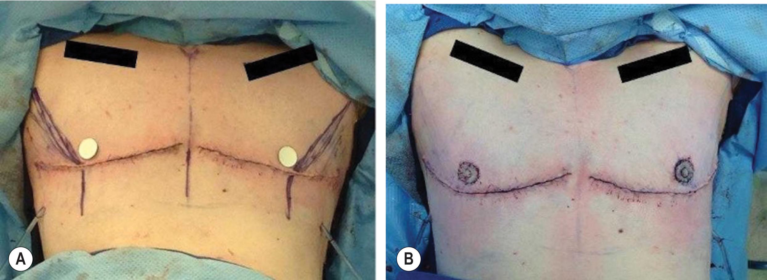 Figure 14.4.6, Free nipple graft positioning and inset. (A,B) NACs are harvested at the beginning of the case within a 2.2 cm circle with the breast held on tension. After completion of the mastectomy, the patient is sat upright on the table and the lateral border of the pectoralis is palpated and marked. Paper templates are used to determine the NAC position, and are placed approximately 1.5–2.5 cm superior and medial to the pectoralis borders. The recipient site is de-epithelialized, and grafts are sutured in place followed by placement of a tie-over bolster.