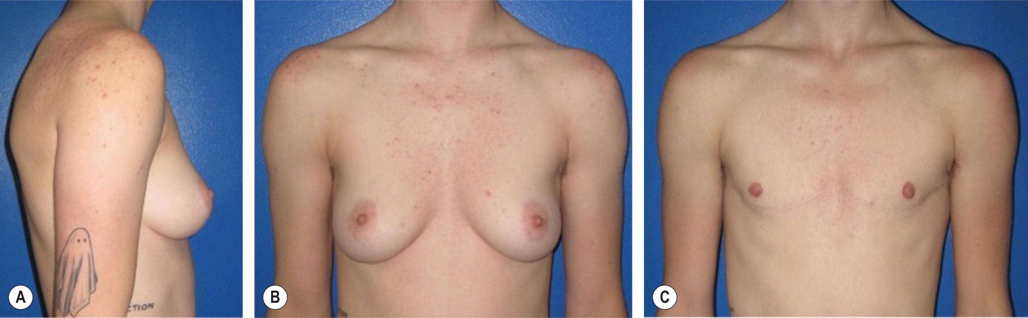 Figure 14.4.8, Preoperative and postoperative photos of chest masculinization using the double incision technique with free nipple grafts. (A) The lateral view demonstrates significant skin laxity with an acute IMF angle. (B) Anteroposterior view shows NACs below the position of the pectoralis border. (C) Postoperative result demonstrates scars camouflaged along the inferior border of the pectoralis muscle.