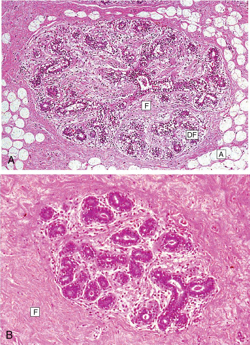 Fig. 15.5, A, Micrograph showing normal breast tissue from a 23-year-old woman. At the center is a breast lobule in which the system of terminal ducts and ductules is embedded in loose intralobular fibrocollagenous stroma (F). There is a narrow surrounding zone of dense extralobular fibrocollagenous support tissue (DF), outside of which is the soft adipose tissue (A) that forms the bulk of the breast. B, Micrograph showing normal breast tissue from a 43-year-old woman. As women age, the amount of fibrocollagenous tissue (F) in the breast increases, replacing some of the adipose tissue. The mammary lobules become enclosed in dense collagen.