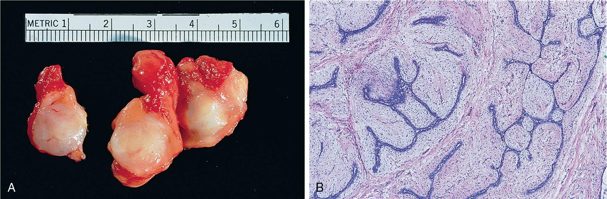 Fig. 15.6, A, Fibroadenoma with a characteristic tan, well-circumscribed nodule. B, Histologic section of fibroadenoma with epithelial cells surrounded by loose mesenchymal fibrous tissue.