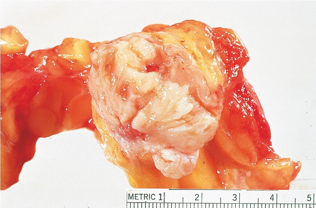 Fig. 15.7, Phyllodes tumor with leaflike projections within the fleshy mass.