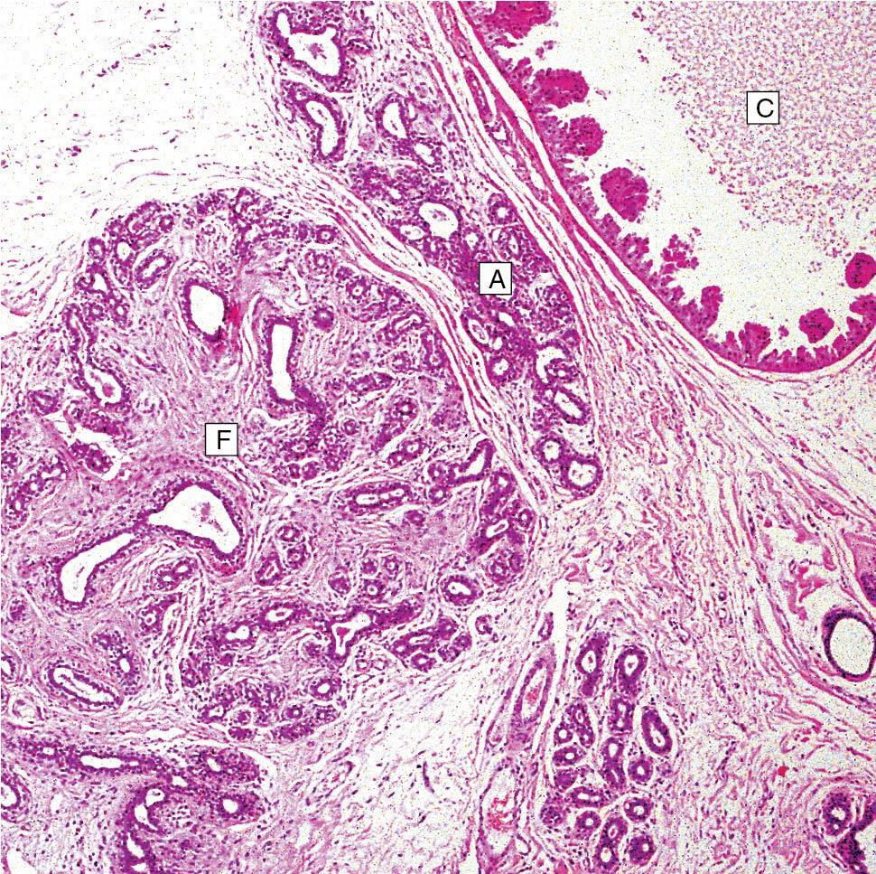 Fig. 15.9, Fibrocystic changes from histologic section. Note fibrosis (F), adenomatous changes with increased ductal tissue (A), and cysts (C).