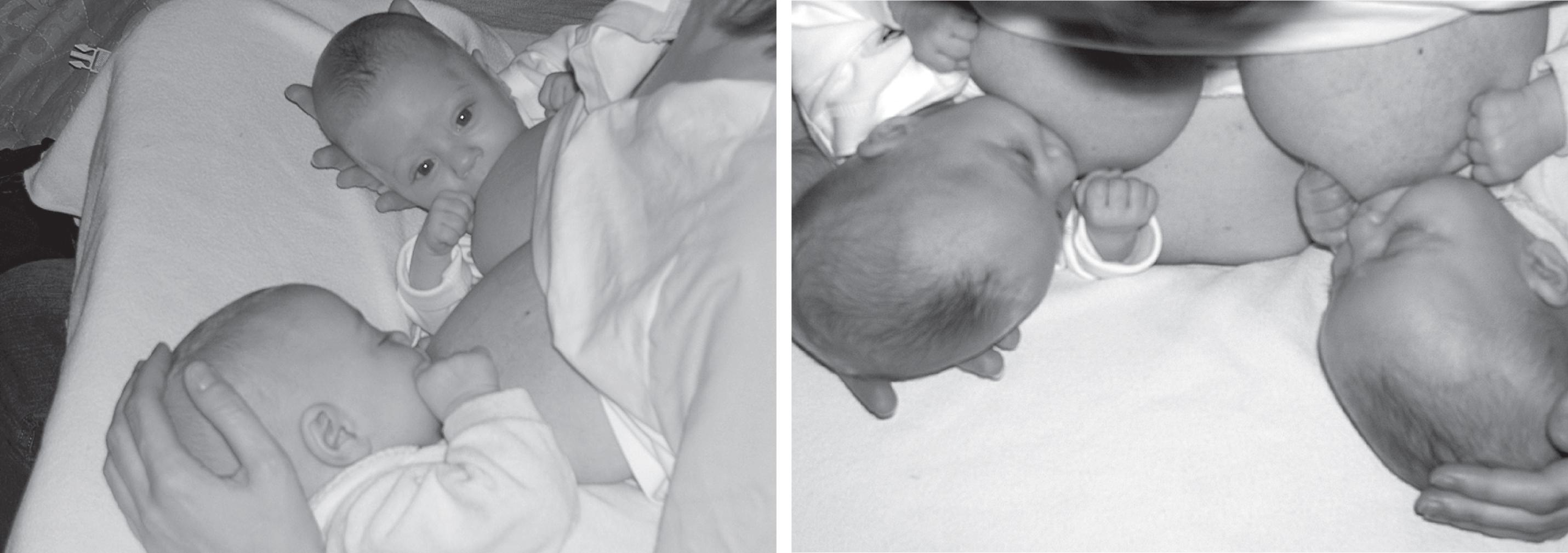 Fig. 13.3, Premature twins nursing simultaneously, resting on a nursing pillow.