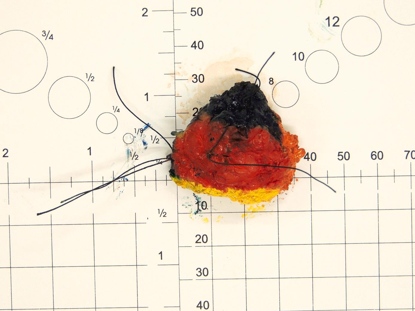 Figure 4.1, An orientated therapeutic wide local excision specimen. The surgeon has used sutures to mark the superior aspect (two stitches), anterior aspect (one long stitch, seen centrally) and nipple (three stitches, left). The pathologist has then differentially inked the specimen, so that the respective margins can be easily identified on histological review. Colour key: blue superior, red anterior, yellow inferior, green medial, orange lateral and black posterior (not seen).