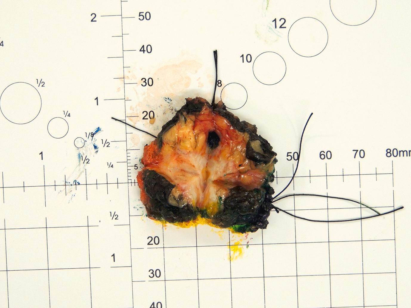 Figure 4.2, A ‘cruciated’ wide local excision specimen. After inking, the specimen has been incised from the posterior surface in a cruciate fashion (i.e. into quarters). The tumour can be seen centrally.