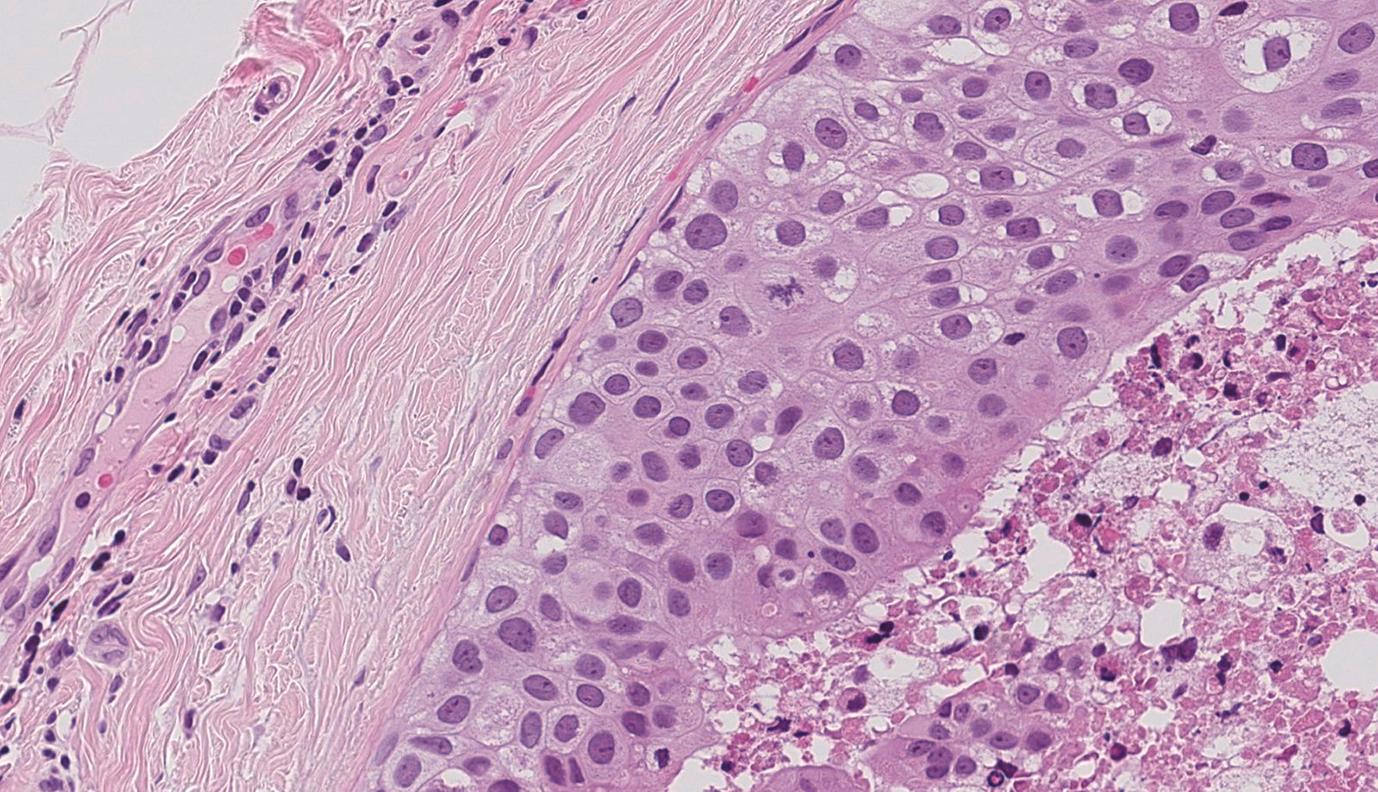 Figure 4.3, High-grade, solid architecture ductal carcinoma in situ with central necrosis of comedo type. The atypical epithelial cells are markedly pleomorphic, with enlarged nuclei and atypical mitoses. The myoepithelial cell layer and basement membrane are intact.