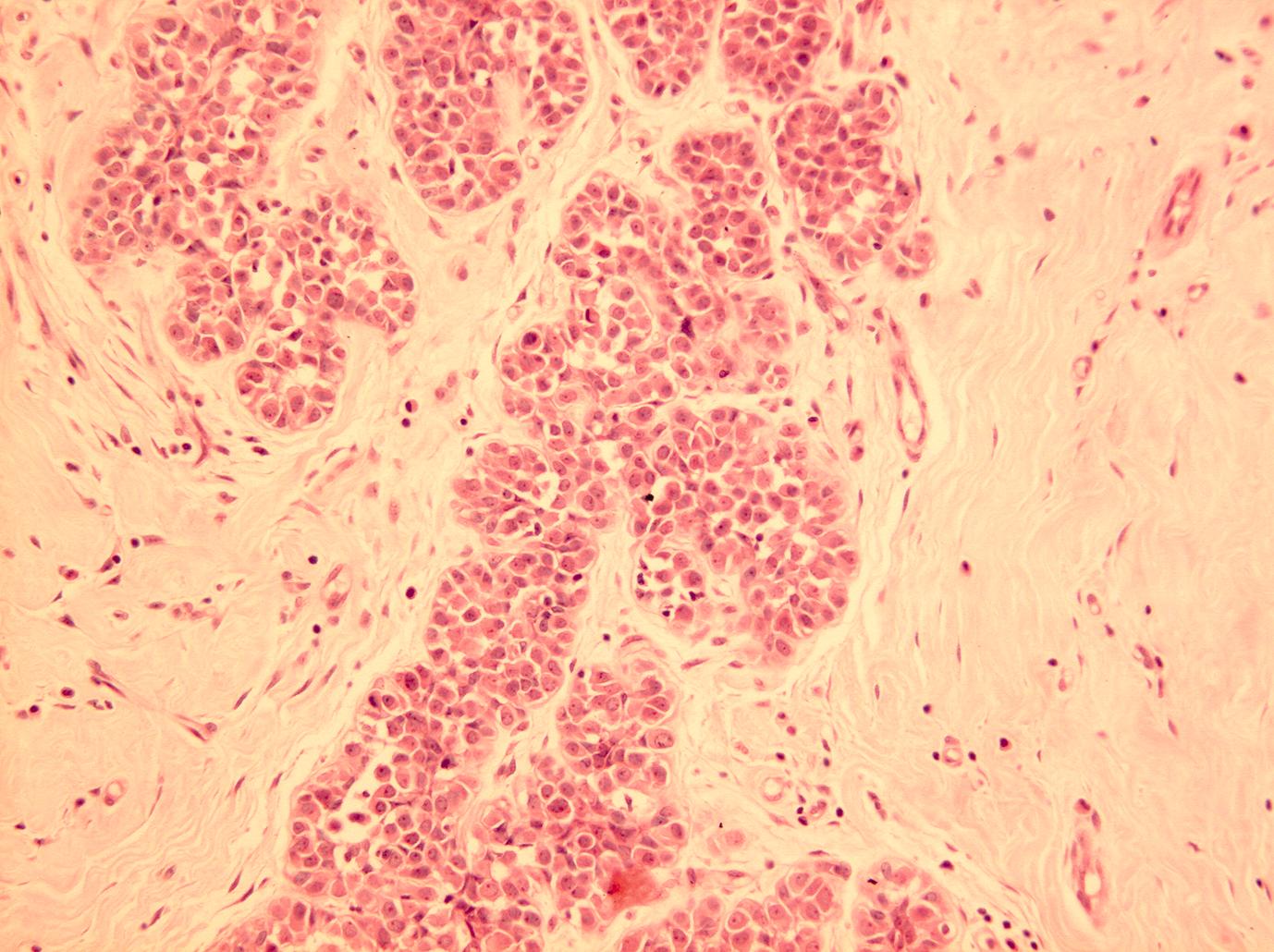 Figure 4.4, Atypical lobular hyperplasia (ALH). ALH consists of discohesive, uniform cells filling and distending <50% of the terminal duct lobular unit.