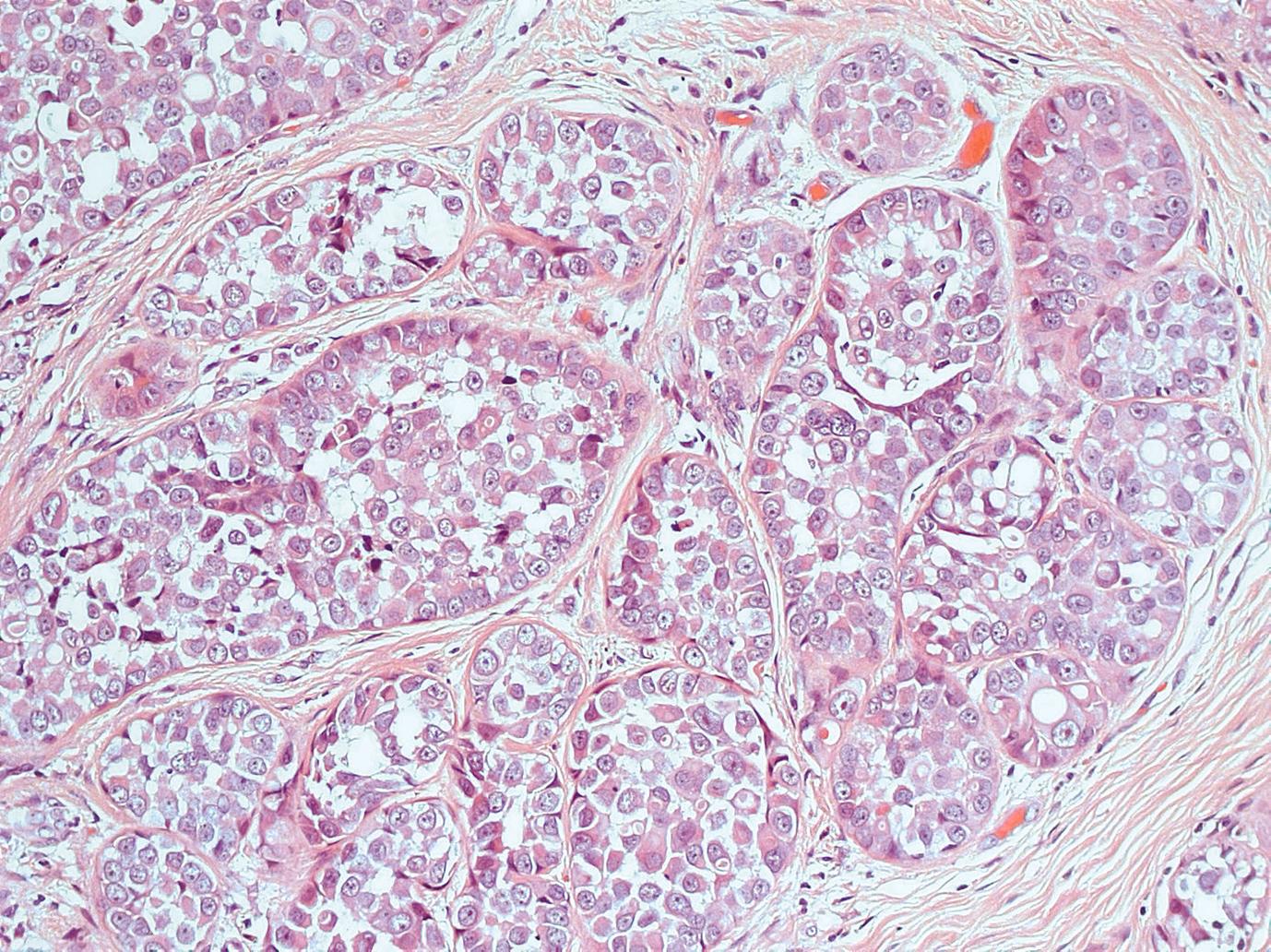 Figure 4.5, Pleomorphic lobular carcinoma in situ (PLCIS). A population of discohesive cells is seen occupying >50% of the terminal duct lobular unit, fulfilling the criteria for a diagnosis of LCIS. However, as opposed to classical LCIS in which the cells are moderately sized and relatively uniform, these cells are large and pleomorphic with prominent nucleoli.