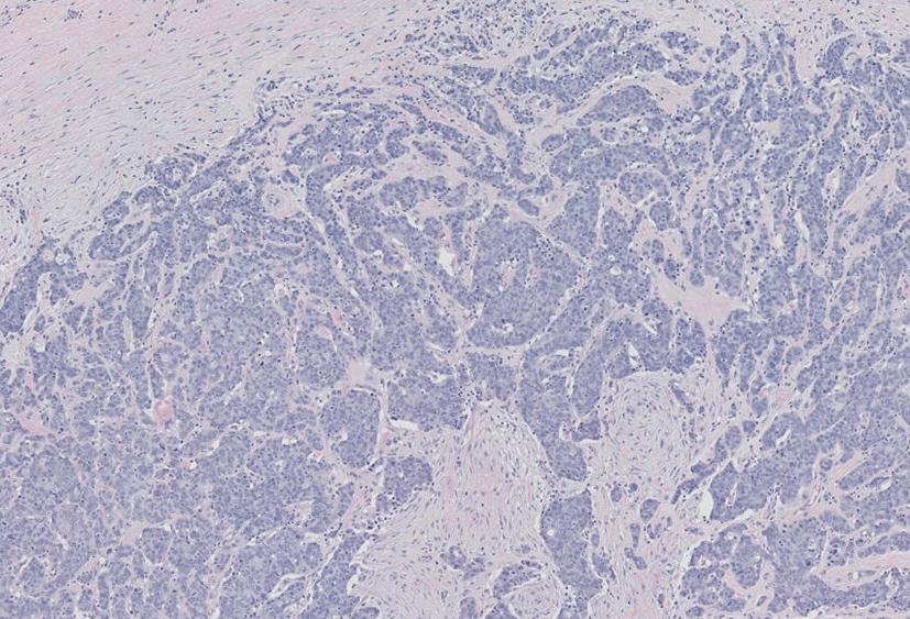 Figure 4.6, Invasive carcinoma of no special type (NST). NST tumours account for 50–75% of all invasive breast cancers and show no distinguishing histological features. In this example, no gland/tubule formation is seen, with closely packed, irregularly arranged solid islands and sheets of tumour infiltrating into the surrounding stroma.