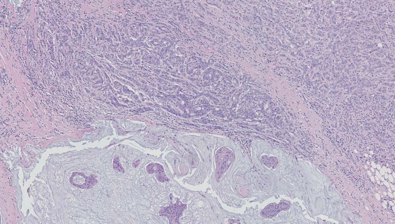 Figure 4.7, A mixed tumour, showing areas of no special type (upper portion) and mucinous differentiation (lower area), in the latter tumour nests floating in pools of mucin.