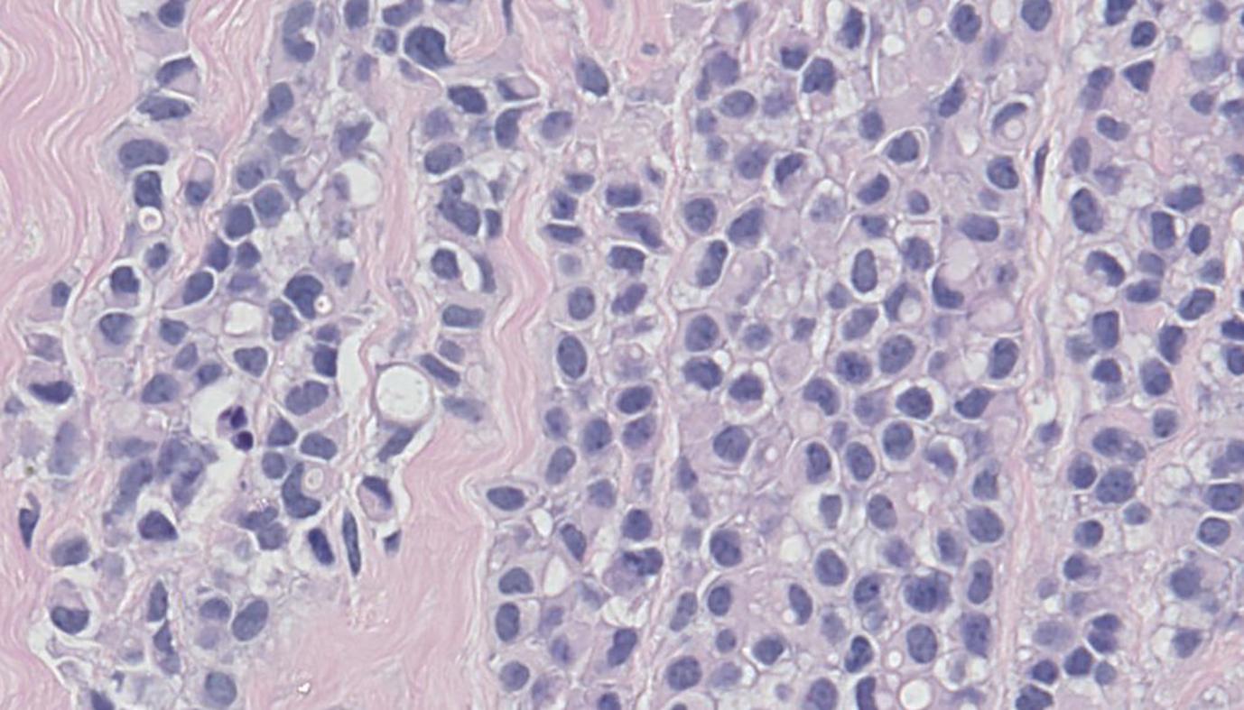 Figure 4.8, High power view of invasive lobular carcinoma. The malignant cells are discohesive, moderately sized with little cytoplasm, bearing intracytoplasmic vacuoles.