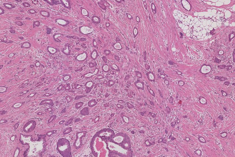Figure 4.9, Tubular carcinoma. This well-differentiated, low-grade invasive cancer consists predominantly (≥90%) of angulated tubules in a desmoplastic stroma.