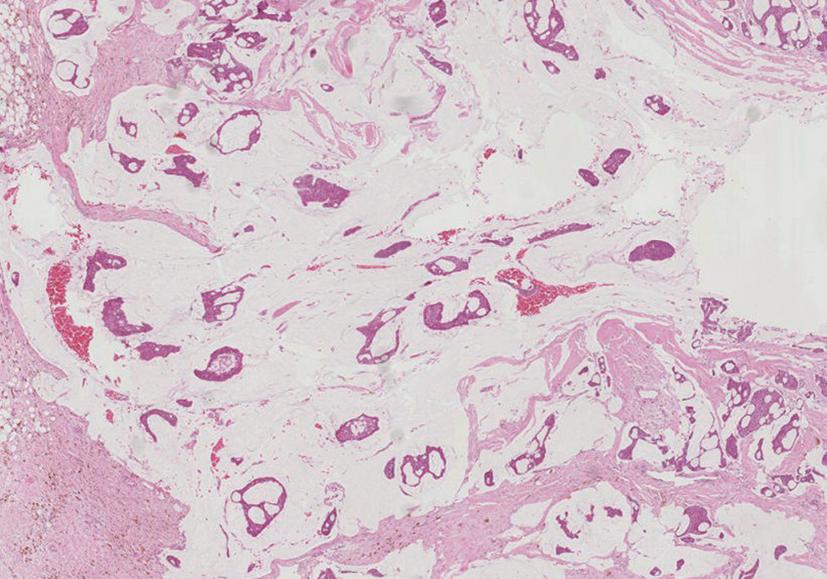 Figure 4.10, Invasive mucinous carcinoma. Small islands of malignant glands are seen within pale pools of mucin.