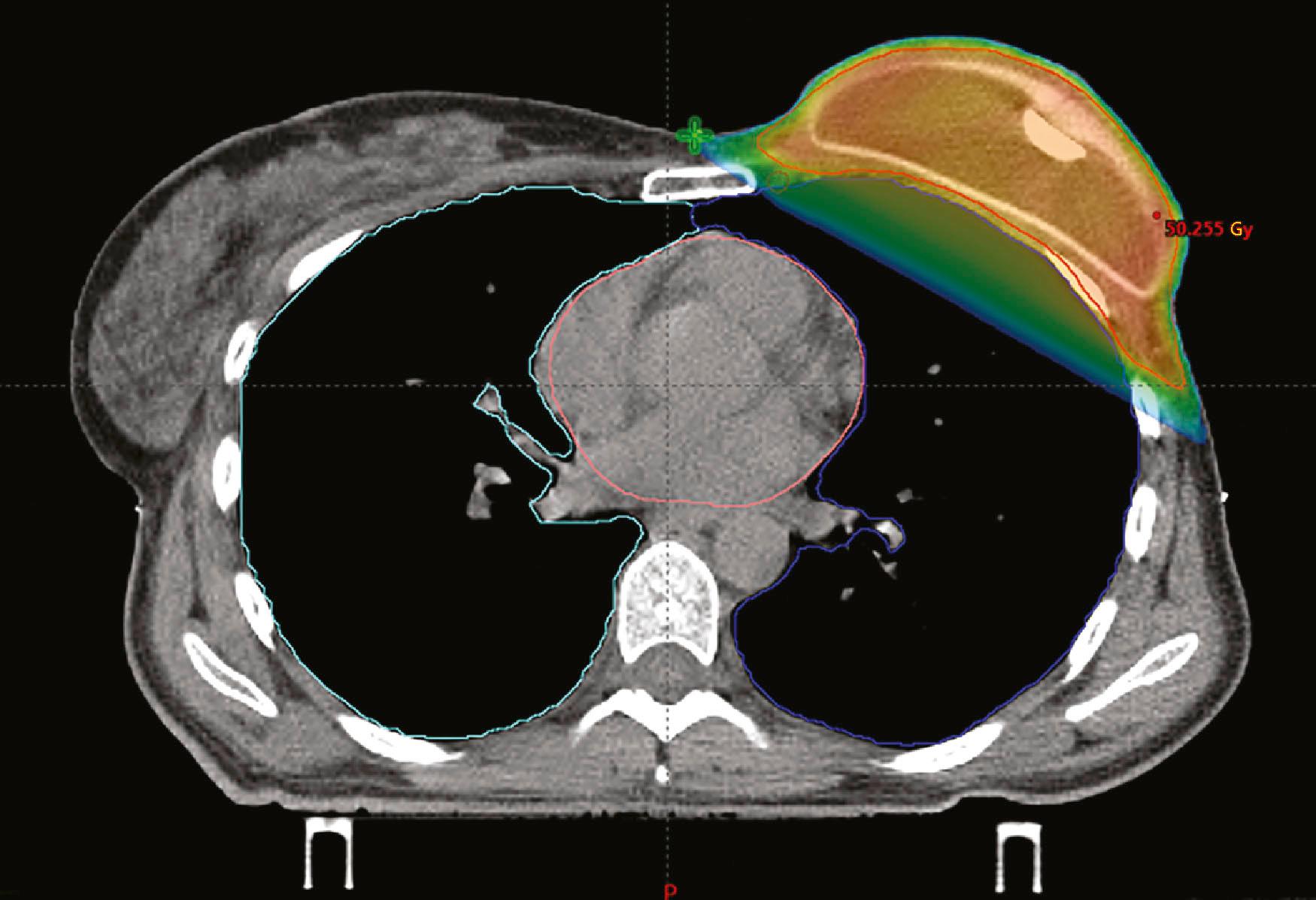 Figure 48.2, Dose distribution for postmastectomy radiotherapy in a patient with first-stage reconstruction with tissue expander.