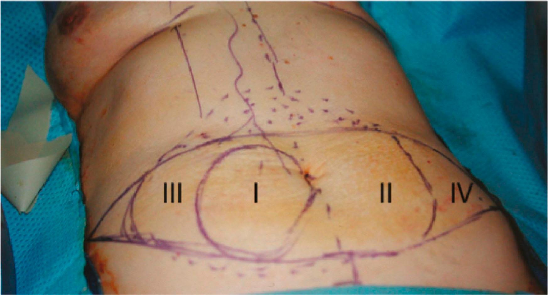 Figure 28.1, Vascular zones (I, II, III, IV) of right-sided TRAM flap.