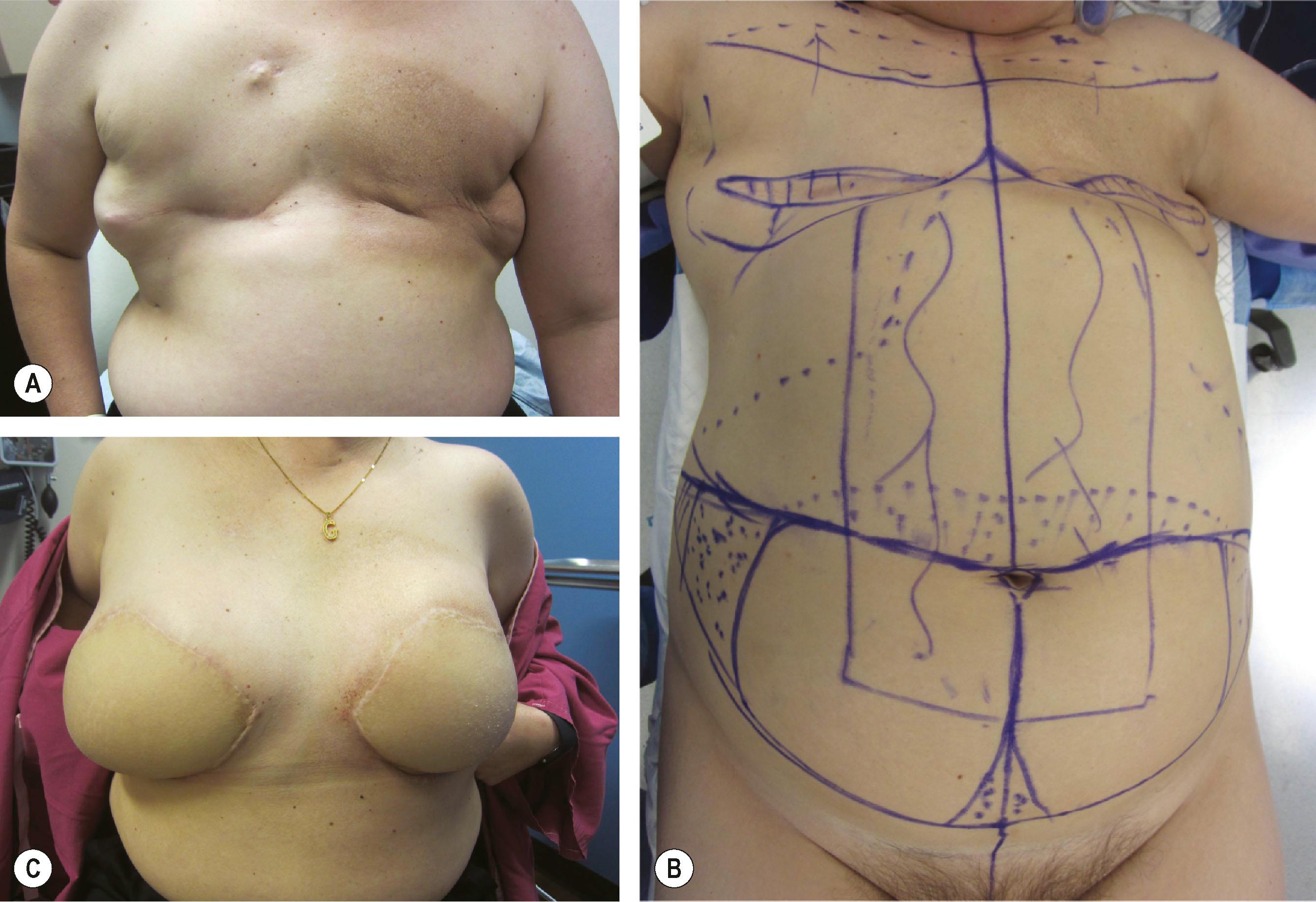 Figure 28.2, Case example of a patient needing bilateral breast reconstruction in setting of prior irradiation to her left breast. (A) Preoperative picture. (B) Intraoperative markings for a bilateral TRAM flap. (C) 10-month postoperative result.