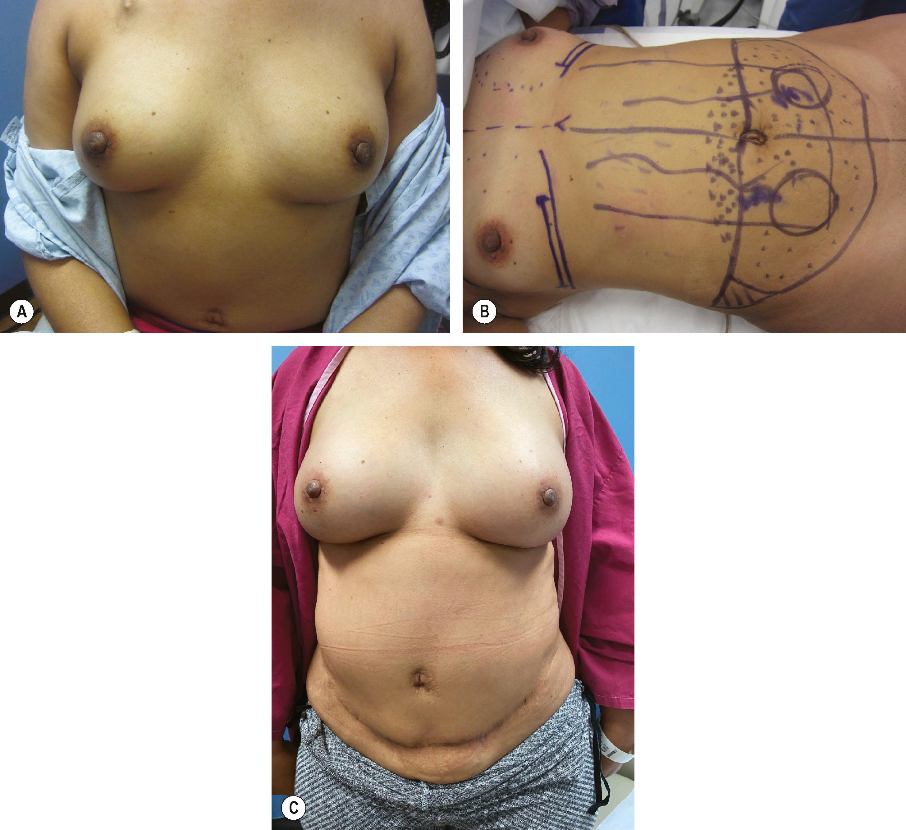 Figure 28.3, Case example of a patient who underwent bilateral skin and nipple-sparing mastectomies with bilateral de-epithelialized TRAM flaps. (A) Preoperative photo. (B) Intraoperative markings with planned mastectomies through an inframammary fold incision. (C) 3-year postoperative result.