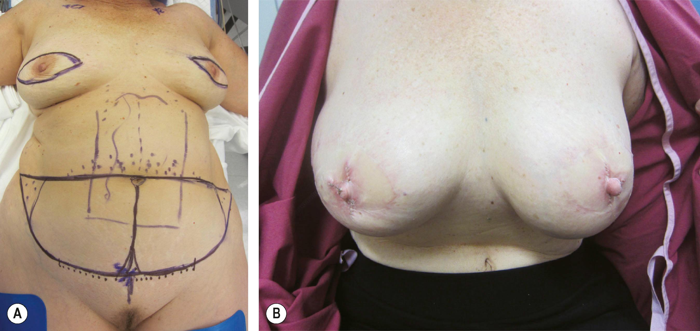 Figure 28.5, Case example of a bilateral immediate TRAM flap reconstruction. (A) Intraoperative markings. (B) Patient result 2 weeks after her nipple reconstruction, 11 months after her original reconstruction.