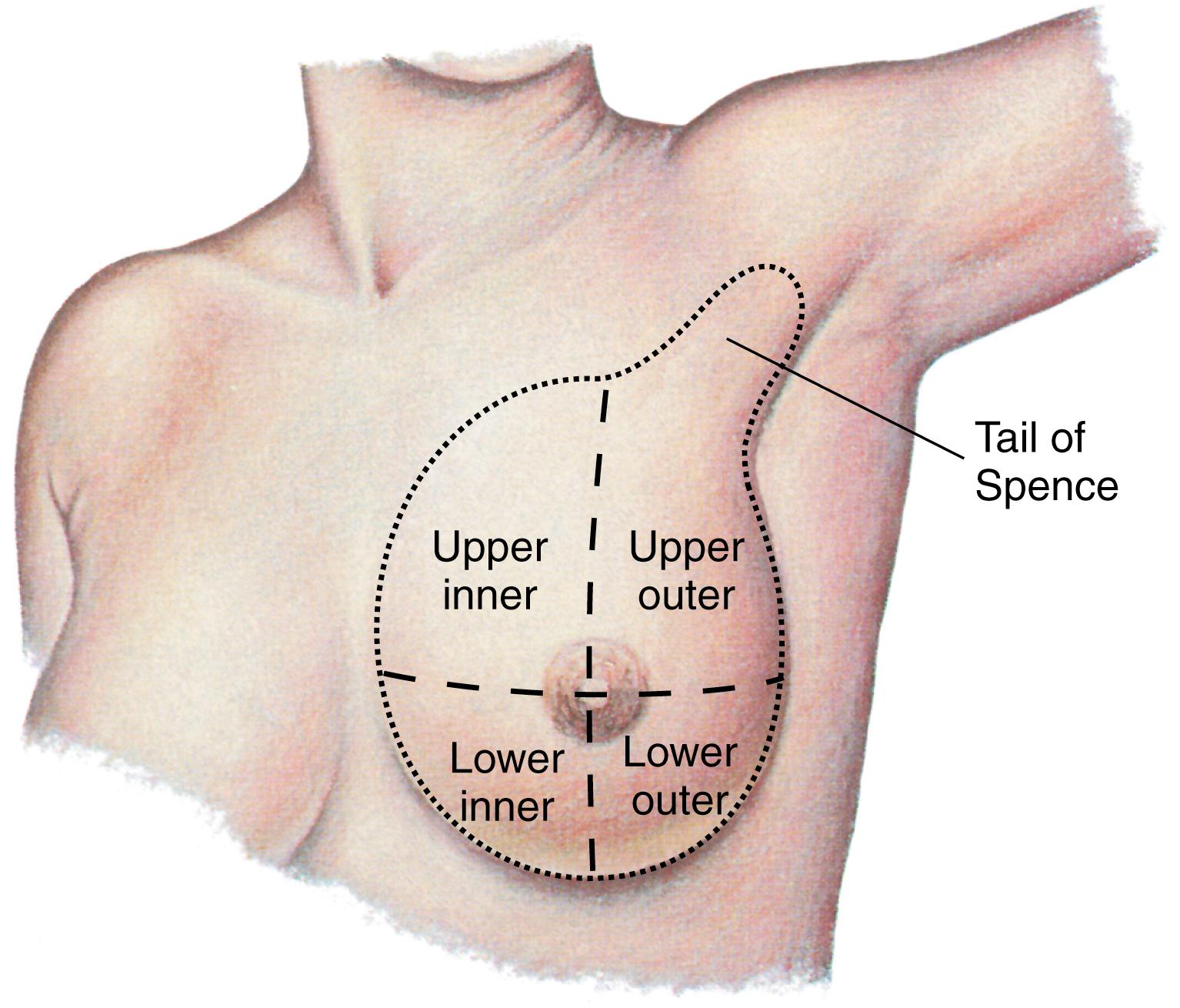 FIG. 17.2, Quadrants of the left breast and axillary tail of Spence.