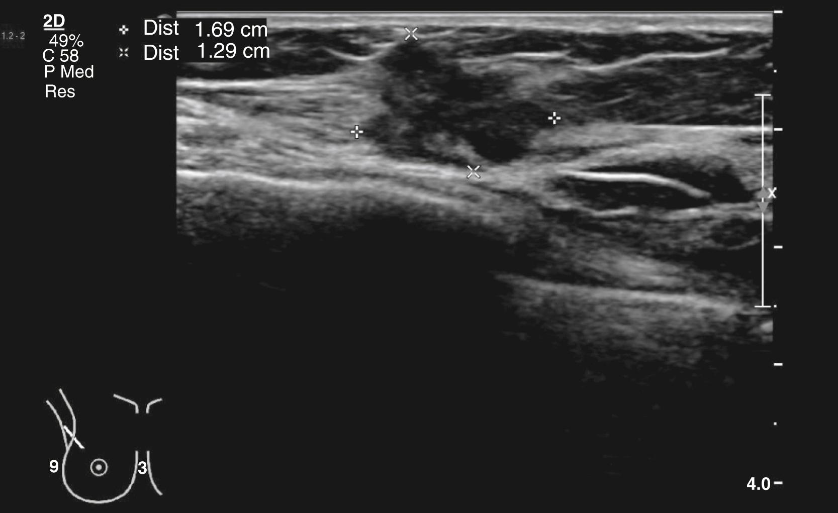 Fig. 20.17, Ultrasound scan of a dense irregular lesion due to a breast cancer.