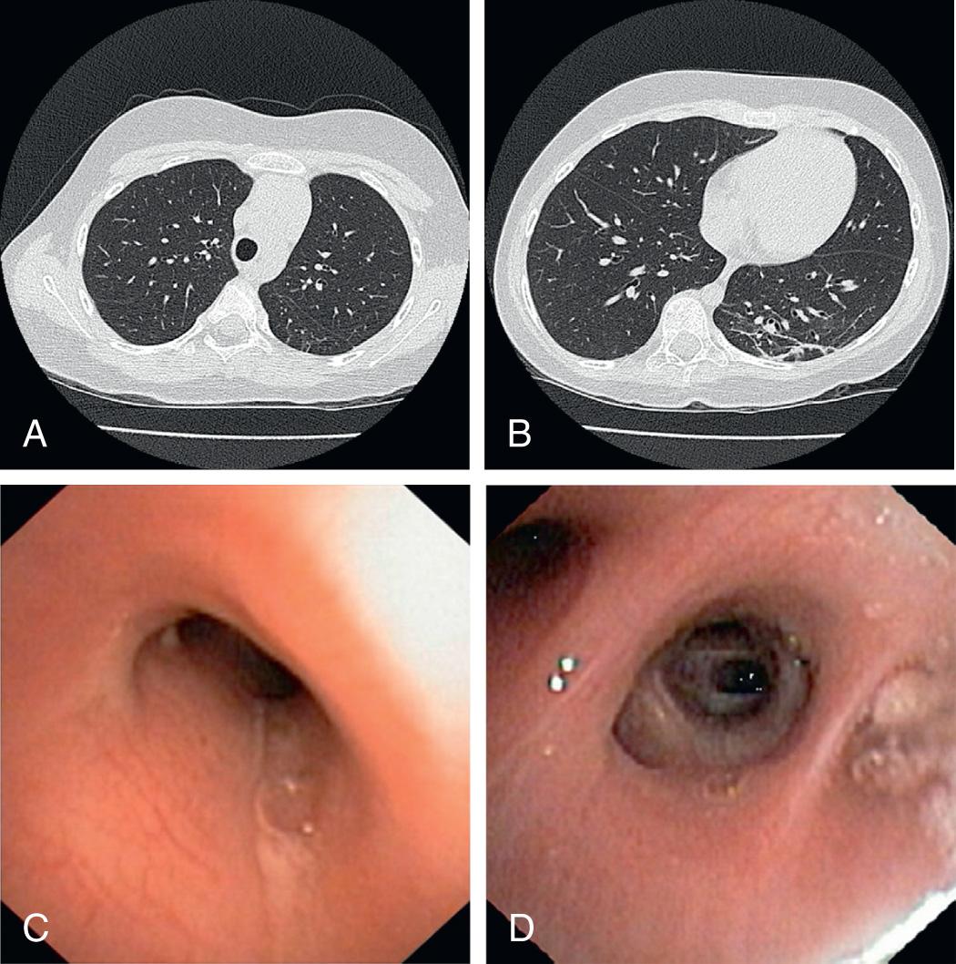 Fig. 430.1, Chest high-resolution computed tomography scan ( A and B ) and bronchoscopy ( C and D ) in a child with bronchiectasis. ( C and D ) Bronchoscopy findings. Images from a chest high-resolution computed tomography (cHRCT) scan ( A and B ) in a 10 yr old girl who presented with a chronic wet cough. The child was treated with a 2-wk course of IV antibiotics (after failing oral antibiotic treatment). The scan was reported as having no evidence of bronchiectasis by pediatric radiologists. At bronchoscopy thick mucopus was seen in the trachea ( C ) and the right lower lobe ( D ). The case highlights the need to consider the diagnosis of bronchiectasis on the basis of history, examination findings and using the pediatric cutoff (bronchoarterial ratio >0.8) 104 for defining bronchiectasis on the cHRCT scan.