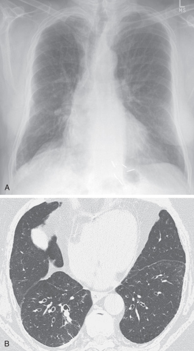 Fig. 57.1, Bronchiectasis evident only on CT. (A) Chest radiograph shows no abnormality. (B) High-resolution CT image shows dilatation of subsegmental bronchi (in relation to adjacent pulmonary artery) characteristic of bronchiectasis.