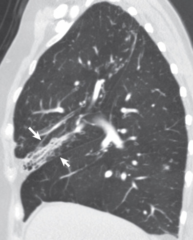 Fig. 57.11, Right middle lobe atelectasis in a patient with right middle lobe bronchiectasis caused by chronic nontuberculous mycobacterial infection. Sagittal CT image shows varicose bronchiectasis and volume loss of the right middle lobe. The minor fissure is displaced inferiorly and posteriorly (long arrow), and the right major fissure is displaced anteriorly and superiorly (short arrow).