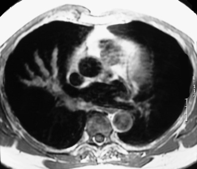 Fig. 57.12, Mucus-filled bronchi on MRI. T1-weighted MRI shows branching opacity in the right middle lobe consistent with mucoid impaction. Note mucus filling the bronchus intermedius.