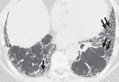 Fig. 57.13, Traction bronchiectasis and bronchiolectasis in idiopathic pulmonary fibrosis. High-resolution CT image shows peripheral predominant reticulation, architectural distortion, and honeycombing. Note associated dilatation and beading of bronchi and bronchioles (traction bronchiectasis and traction bronchiolectasis) (arrows).