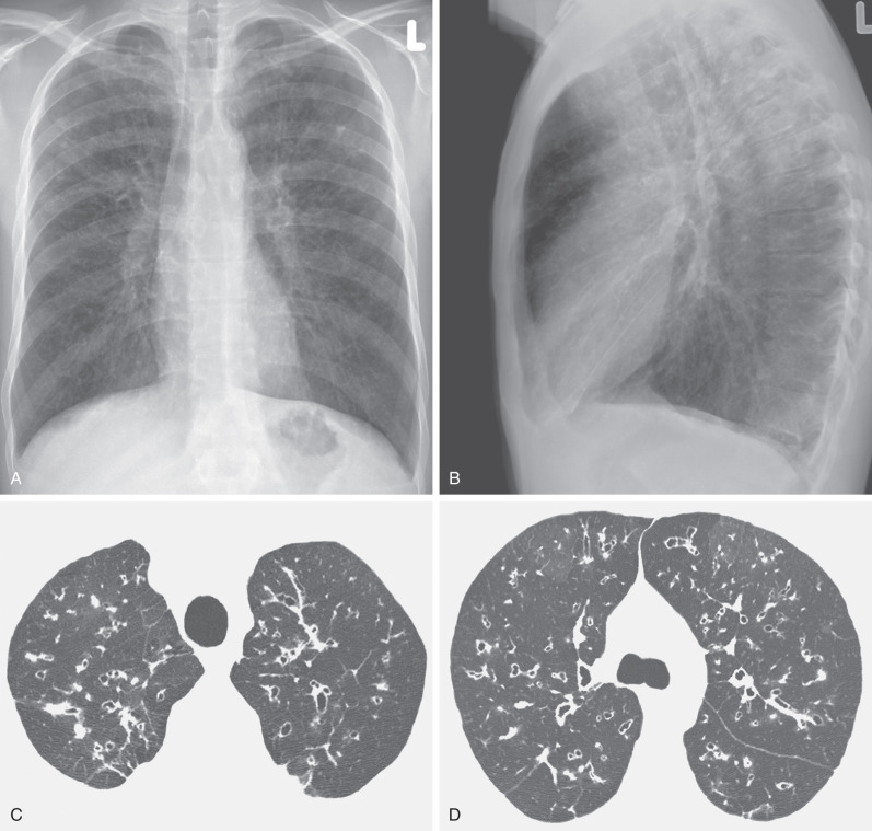 Fig. 57.14, Cystic fibrosis, radiographic and high-resolution CT findings. Posteroanterior (A) and lateral (B) chest radiographs show poorly defined nodular and linear opacities mainly in the upper lobes. Mild hyperinflation with increase in the retrosternal airspace is noted. High-resolution CT scans at the level of the lung apices (C) and tracheal carina (D) show extensive bilateral bronchiectasis and areas of decreased attenuation and vascularity (mosaic attenuation).