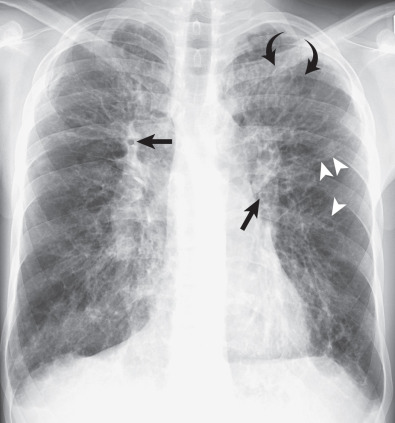 Fig. 57.15, Cystic fibrosis, radiographic findings. Posteroanterior chest radiograph shows marked bronchial wall thickening (straight arrows) and extensive varicose (arrowheads) and cystic (curved arrows) bronchiectasis. Note hyperinflation and enlarged central pulmonary arteries consistent with pulmonary arterial hypertension.