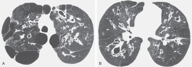 Fig. 57.16, Cystic fibrosis, high-resolution CT findings. (A) High-resolution CT scan at the level of the lung apices shows extensive bronchiectasis and bullous changes. (B) High-resolution CT scan at the level of the inferior pulmonary veins shows bilateral varicose and cystic bronchiectasis and areas of decreased attenuation and vascularity.