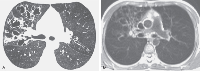 Fig. 57.17, Cystic fibrosis. Comparison between high-resolution CT and MRI findings in a child. (A) High-resolution CT scan shows right upper lobe cystic and varicose bronchiectasis. Cylindrical and varicose bronchiectasis is evident in the left upper lobe. Note mosaic lung attenuation. (B) T1-weighted MR image obtained at a similar level as in (A) shows bronchiectasis in the right upper lobe. Milder areas of bronchiectasis in the left upper lobe and findings of small airway disease are not apparent on the MR image .