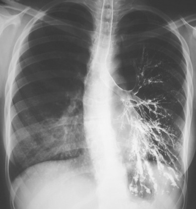 Fig. 57.2, Bronchiectasis on bronchography. Bronchogram shows normal diameter and tapering of the left upper lobe and lingular bronchi and cylindrical and varicose left lower lobe bronchiectasis.