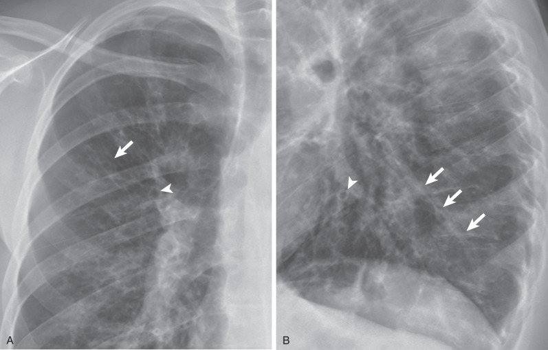 Fig. 57.3, Radiographic signs of bronchiectasis in cystic fibrosis. Magnified views of frontal (A) and lateral (B) chest radiographs demonstrate multiple ring shadows (arrowheads) and tram-line opacities (straight arrows) consistent with bronchiectasis.