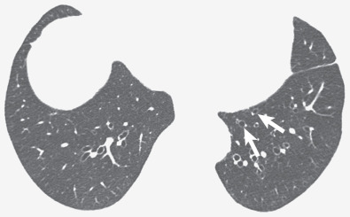 Fig. 57.5, Bronchiectasis: “signet ring” on CT. High-resolution CT shows several bronchi with a luminal diameter greater than the adjacent pulmonary artery. This appearance of a dilated airway and the normal-size adjacent pulmonary artery in patients with bronchiectasis has been likened to a signet ring (arrows).