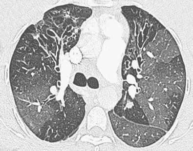 Fig. 57.7, Varicose bronchiectasis in cystic fibrosis. High-resolution CT image shows varicose bronchiectasis in both upper lobes. Note striking mosaic attenuation from small airways disease.