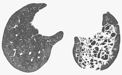 Fig. 57.8, Bronchiectasis and small airways disease. High-resolution CT image shows cystic bronchiectasis in the left lower lobe. No bronchiectasis is seen in the right lower lobe, but there is mosaic attenuation consistent with constrictive bronchiolitis.