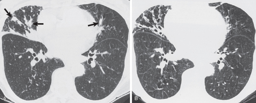 Fig. 57.9, Mucus-filled bronchi. (A) High-resolution CT image shows tubular and nodular (arrows) opacities in the right middle lobe and lingula. (B) High-resolution CT performed after expectoration of the mucus shows that the opacities represented ectatic bronchi filled with secretions. In this case, bronchiectasis was a result of previous tuberculosis.