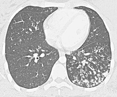 Fig. 57.10, Mucoid impaction in bronchiectasis. High-resolution CT image shows numerous V- and Y-shaped branching opacities and a tree-in-bud pattern in the left lower lobe.