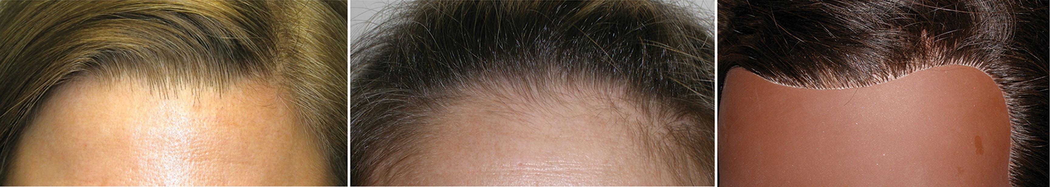 Fig. 4.21, Naturally occurring hairlines are incidental with sparse, fine vellus hairs anteriorly that change to a thicker follicular density posteriorly (left and center) . A “toupee-like” hairline (right) is a straight line and stands out as being very unnatural.