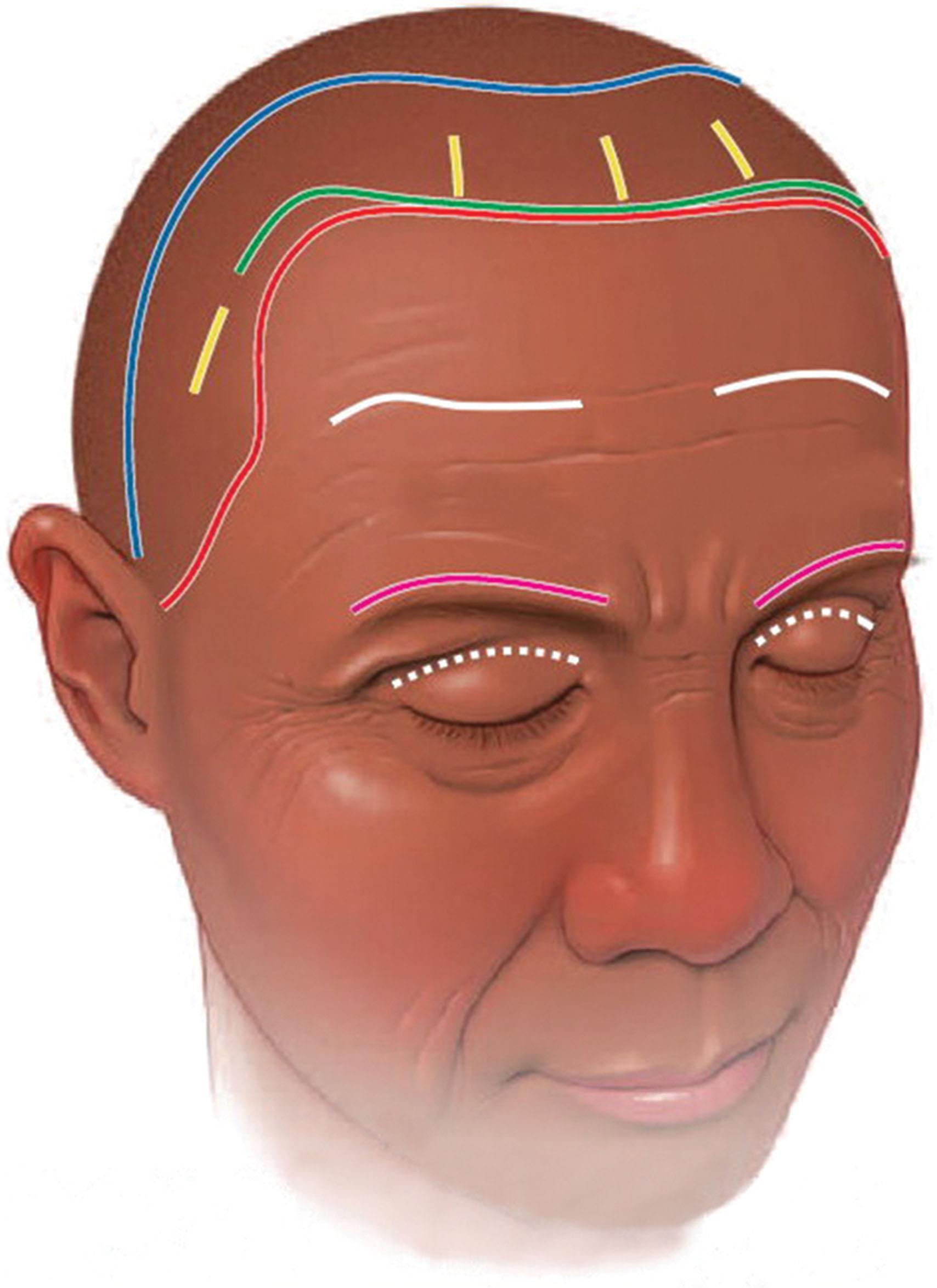 Fig. 4.9, Common browlift approaches include coronal (blue) , transfollicular (green) , endoscopic (yellow) , pretrichial (red) , direct (white) , and trans-blepharoplasty (pink) approaches.