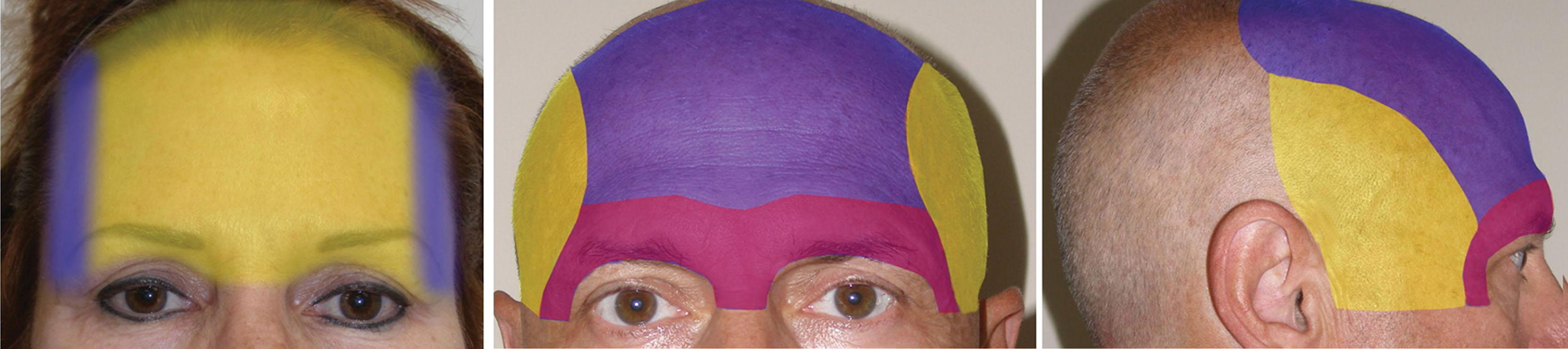 Fig. 4.13, The limited dissection of the transfollicular browlift is shown (left) . The extent of dissection necessary for endoscopic brow and forehead lift (center and right) is a much more aggressive procedure traversing numerous tissue planes.
