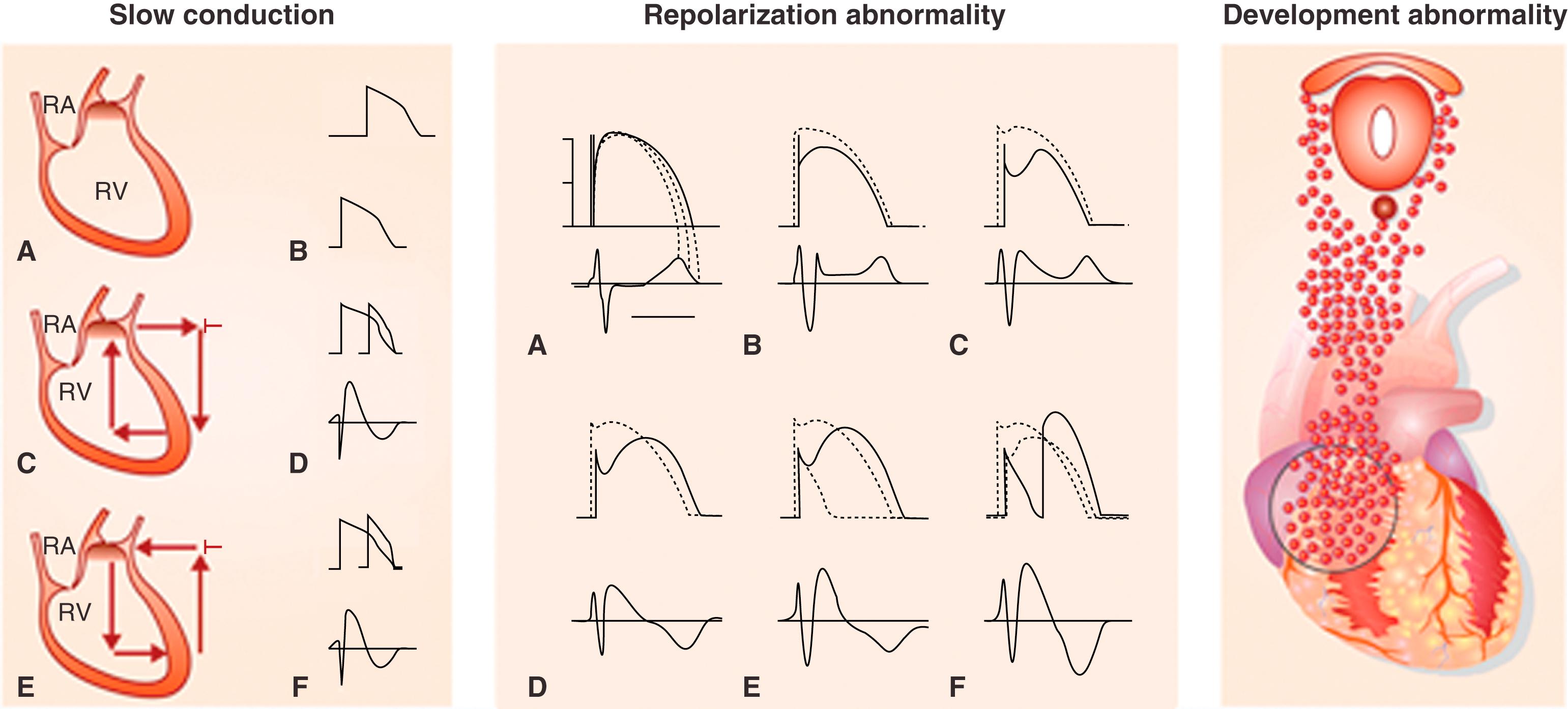 Fig. 95.3, Three possible arrhythmia mechanisms operating in Brugada syndrome. See text for details.