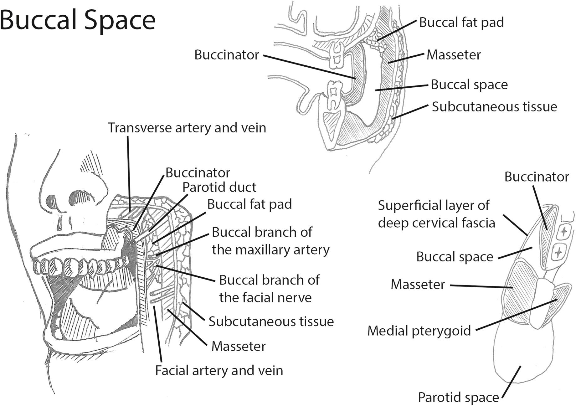 Fig. 43.1, Schematic representation of the buccal space anatomy and its content.