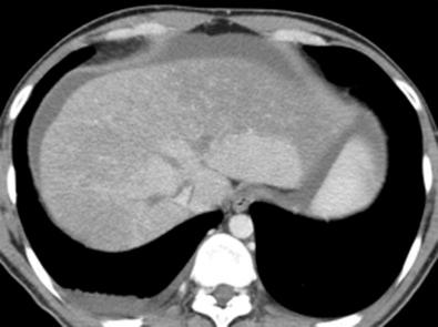 Fig. 44-2, Axial CT section showing the presence of low-density material within the three hepatic veins that corresponds to a total thrombosis.