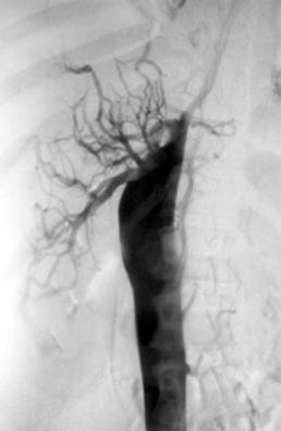 Fig. 44-3, Venography demonstrating the presence of an intrahepatic IVC thrombosis in a 27-year-old woman taking oral contraceptives.