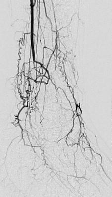 FIGURE 1, Digital subtraction angiogram of the foot of a 37-year-old man with a history of smoking and tissue loss. Note the corkscrew appearance of numerous collaterals. After many efforts at smoking cessation and limb salvage, he ultimately underwent amputation.