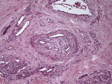 FIGURE 2, Thromboangiitis obliterans findings in an amputation specimen. The arterial lumen is occluded by thrombus; vessel wall and thrombus are infiltrated with multinucleated giant cells and leukocytes.