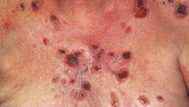 FIGURE 16-2, Pemphigus vulgaris. Multiple erosions on the trunk of this patient were preceded by blisters.